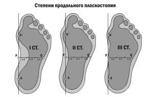 Ploskostopie 6 300x190 Плоскостопие и болевые синдромы